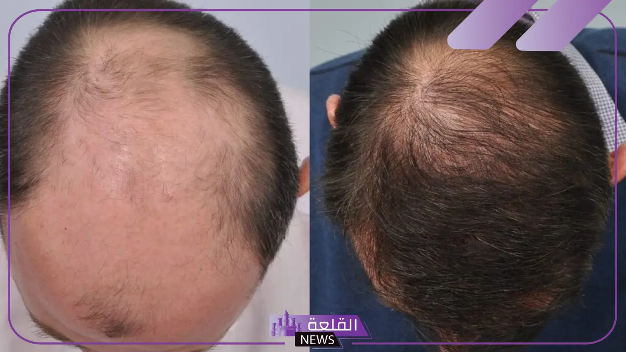 طفرة لعلاج الصلع.. علماء يكشفون طفرة تساعد في علاج الصلع نهائيًا 16 طفرة لعلاج الصلع.. علماء يكشفون طفرة تساعد في علاج الصلع نهائيًا