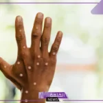 بعد رفع حالة الطوارئ.. الحكومة المصرية تبدأ بمواجهة جدري القردة