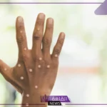 أرقام كارثية.. الصحة العالمية تعلن إصابة 943 ووفاة 4 أشخاص بسبب جدري القرود