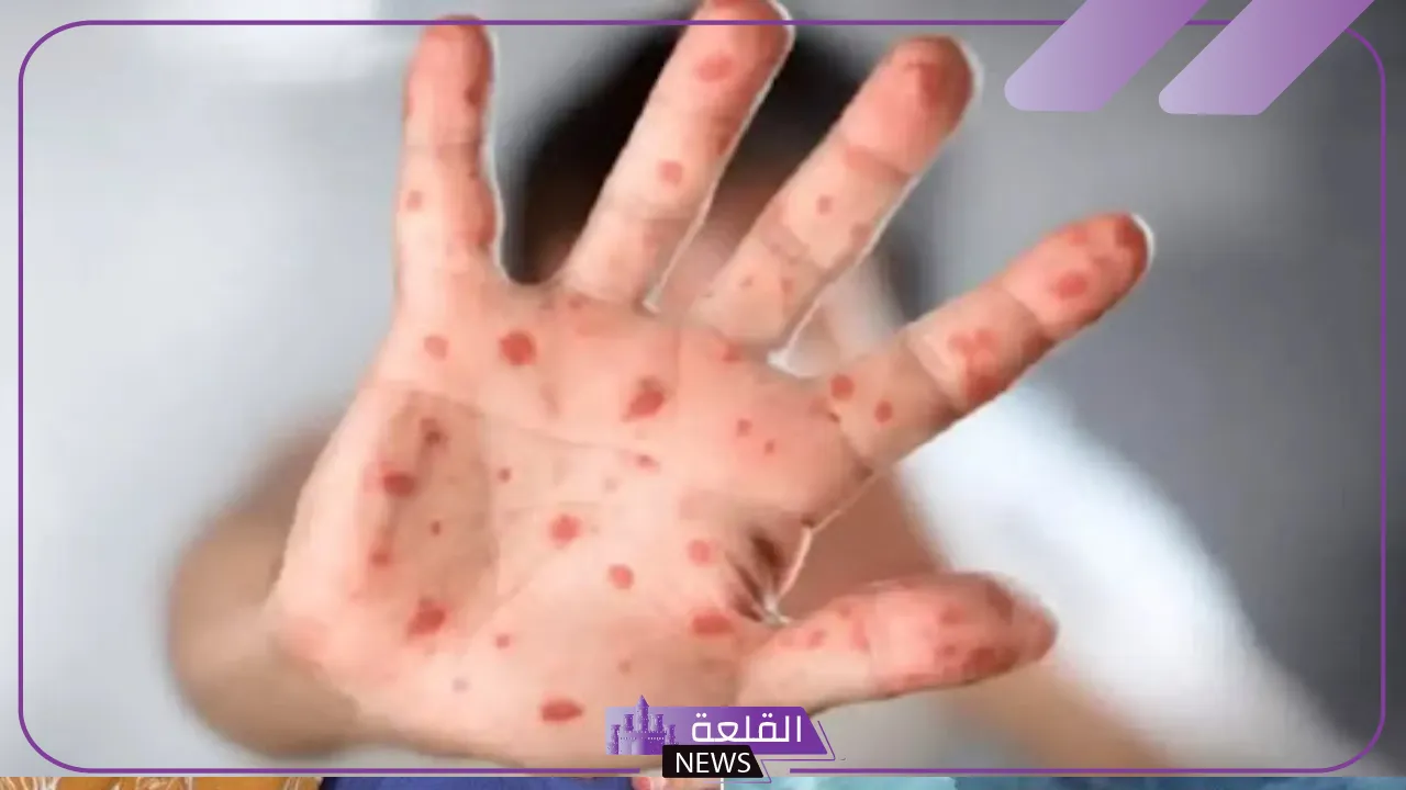 مخاوف عالمية.. جدري القرود ينتشر خارج إفريقيا وتوقعات بجائحة عالمية 5 جائحة جدري القرود هل تعود من جديد