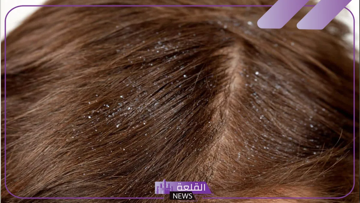 تفسير حلم القمل في الشعر وقتله للمتزوجه والتخلص منه لابن سيرين 5 حلم القمل في المنام بالشعر