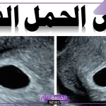 تجربتي مع الحمل بكيس بدون جنين بالأسباب وطرق العلاج