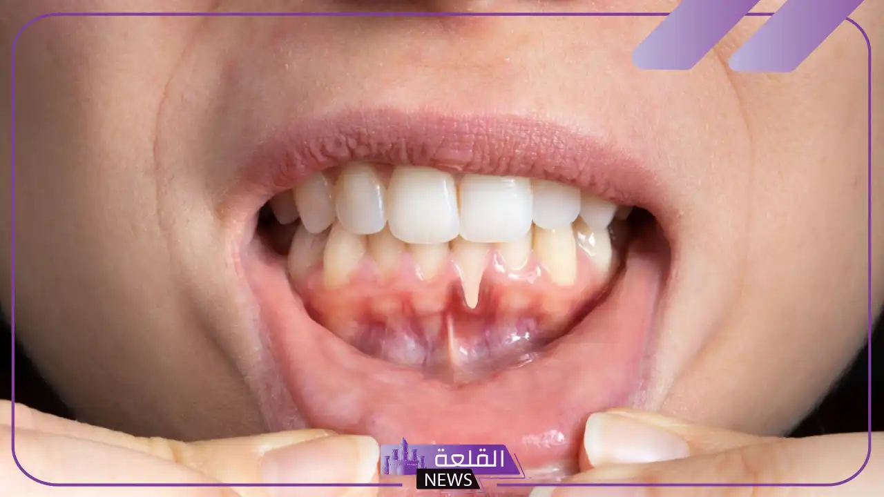 تجربتي مع انحسار اللثه والتنظيف بطرق طبيعية 5 شكل انحسار اللثة