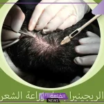 تجربتي مع الريجينيرا لعلاج الصلع الوراثي بالفوائد والأضرار