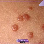 تجربتي مع المليساء المعدية وطريقة العلاج