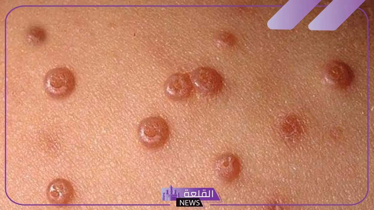 تجربتي مع المليساء المعدية وطريقة العلاج