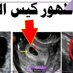 تجربتي في تأخر ظهور الجنين في كيس الحمل