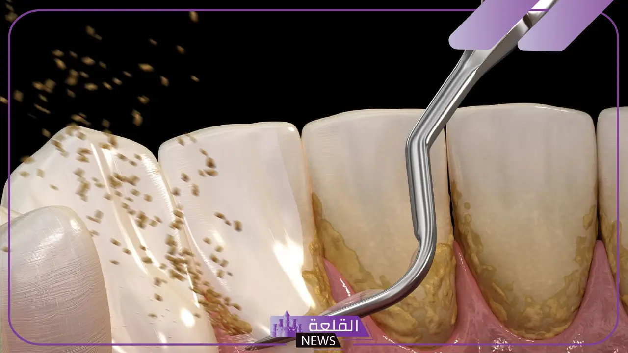 تجربتي مع ازالة جير الاسنان في المنزل بطرق طبيعية 5 القضاء على جير الأسنان