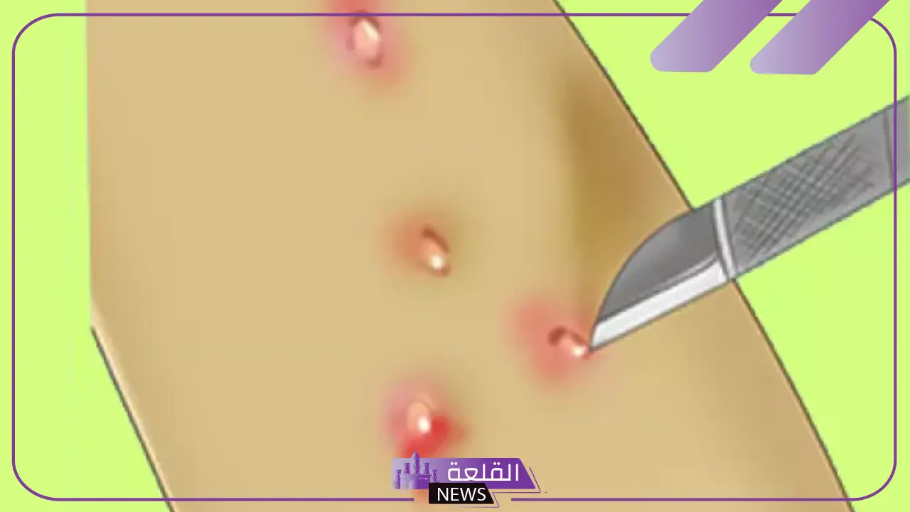 تجربتي مع المليساء المعدية وطريقة العلاج 5 علاج المليساء