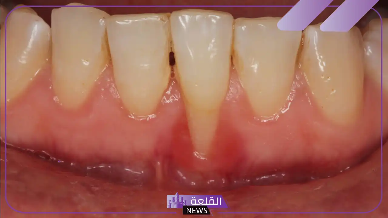 تجربتي مع انحسار اللثه والتنظيف بطرق طبيعية 6 انحسار اللثة السفلية