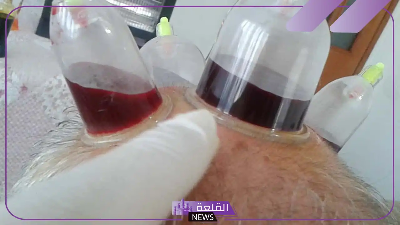 تجربتي مع حجامة الراس لعلاج الألم والخوف 5 هل الصداع بعد الحجامة طبيعي
