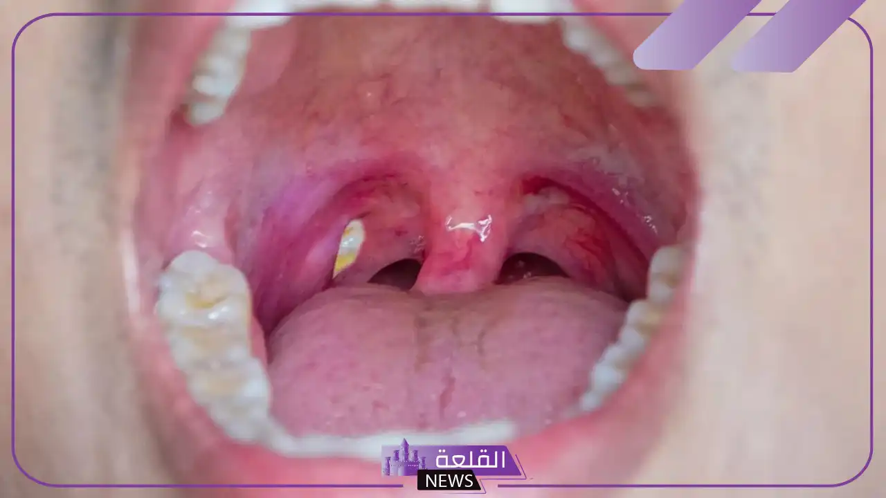 تجربتي مع حصوات اللوز بالأعراض وطرق العلاج 6 إزالة حصى اللوزتين في المنزل
