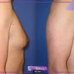 تجربتي مع عملية التثدي ورحلة العلاج