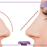 تجربتي مع عملية تجميل الانف والنتيجة.. هل عملية تجميل الأنف تسبب الوفاة؟