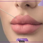 تجربتي مع فيلر جوفيديرم لحقن الشفايف