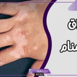 تفسير حلم البهاق في المنام للعزباء والمتزوجة لابن سيرين