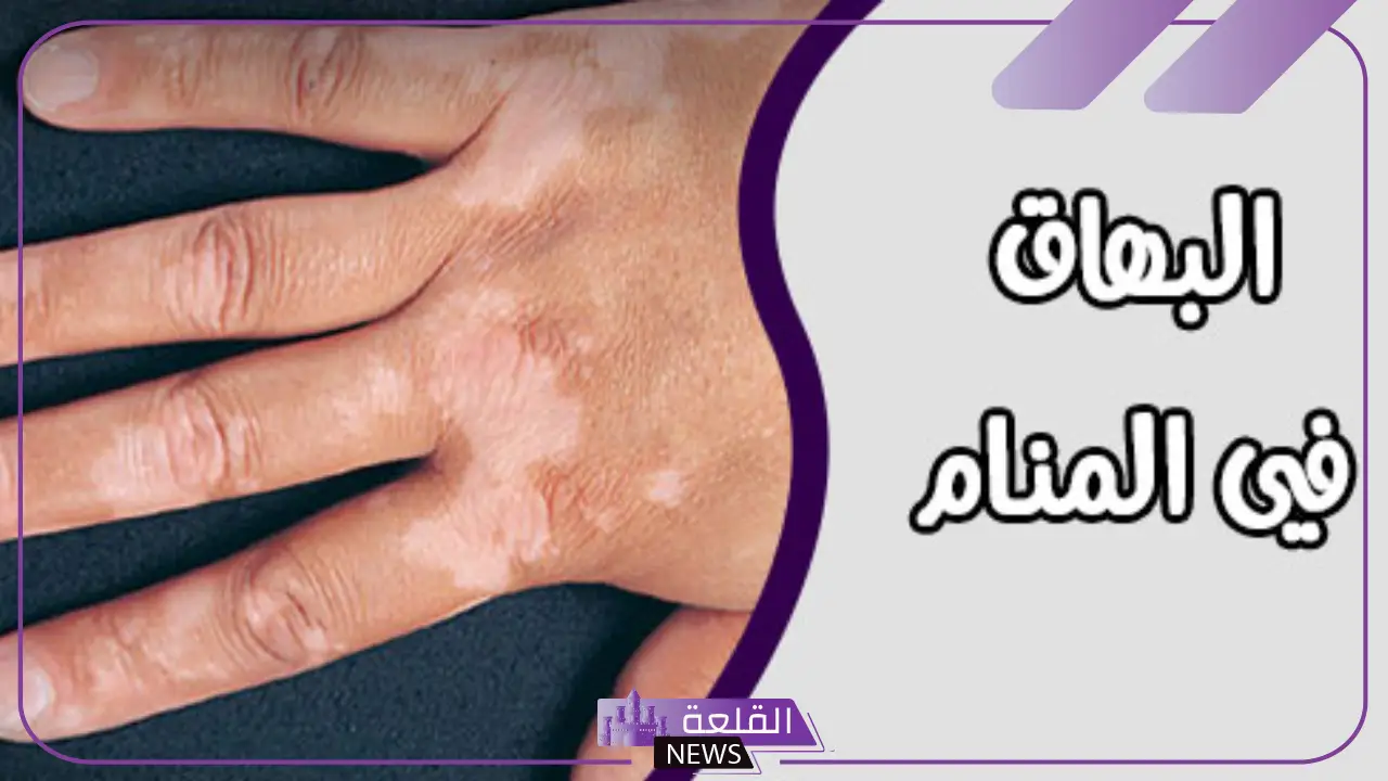تفسير حلم البهاق في المنام للعزباء والمتزوجة لابن سيرين