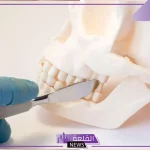 تجربتي مع عملية جراحة الفكين وهل هي مؤلمة؟