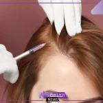 تجربتي مع حقن البلازما للشعر وكيفية استخدامها