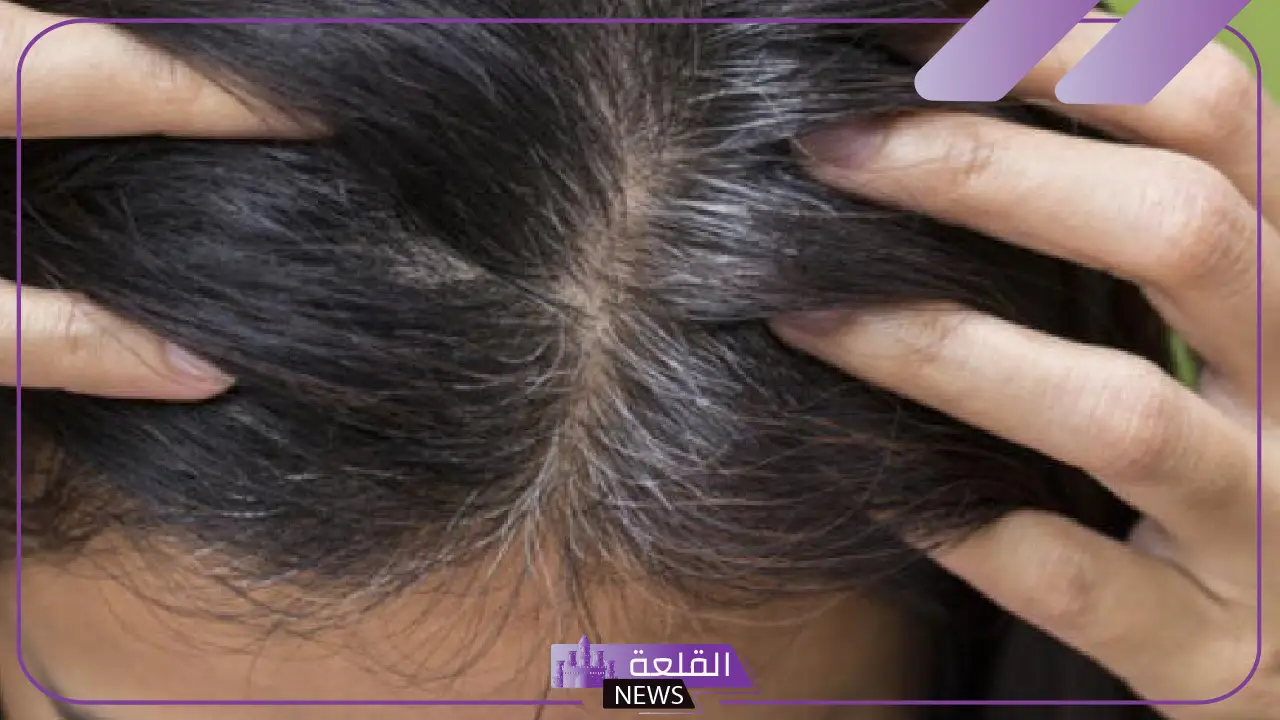 اعرف السبب.. دراسات في جامعة الملك سعود تتوصل لسبب شيب الشعر في مرحلة الشباب 5 دراسة تكشف سبب الشيب في جامعة الملك سعود