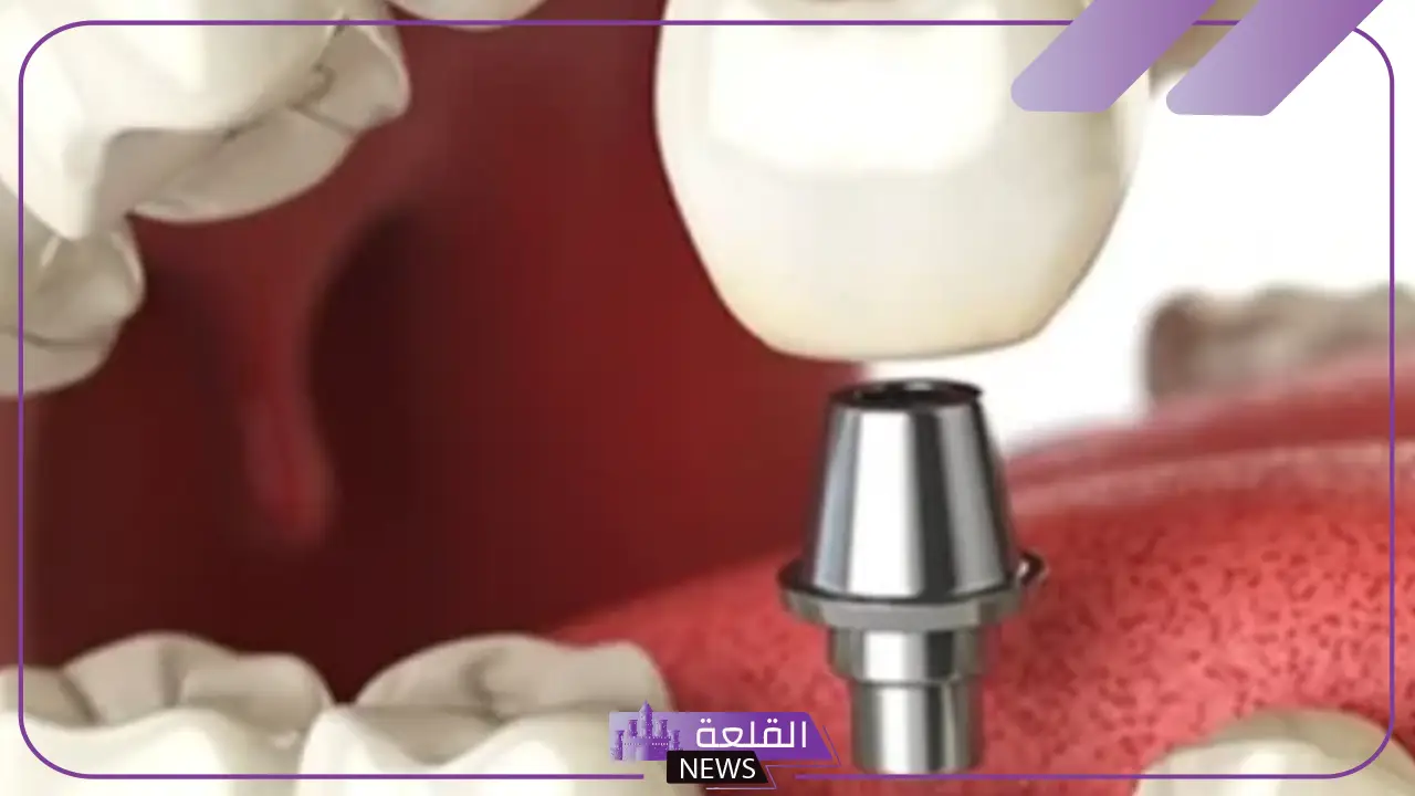تجربتي مع زراعة الأسنان قبل وبعد وأهم المميزات 6 تكلفة زراعة الأسنان