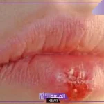 هيئة الدواء.. توضيح بشأن طريقة علاج الهربس “اعرف الطريقة واحمي نفسك”