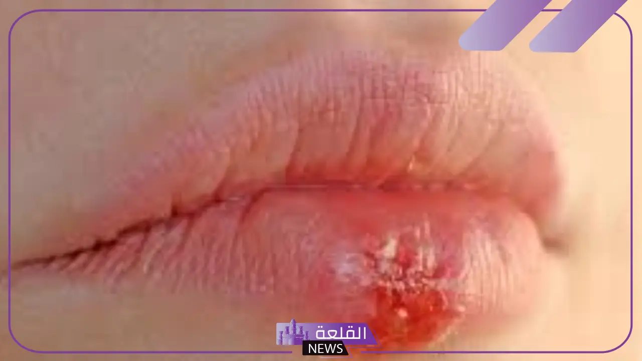 ماهو الهربس