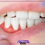 تجربتي مع انحسار اللثه والتنظيف بطرق طبيعية