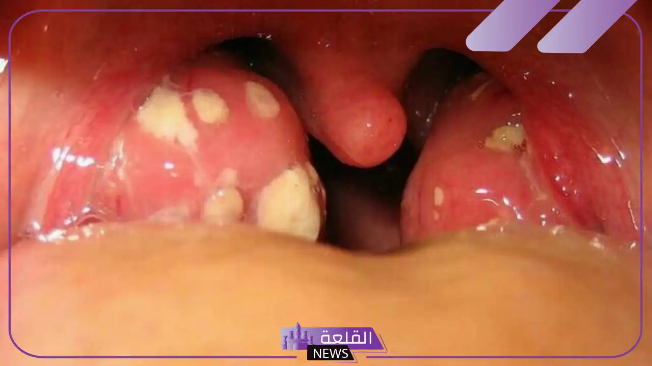 تجربتي مع حصوات اللوز بالأعراض وطرق العلاج 5 علاج حصى اللوزتين بالأعشاب