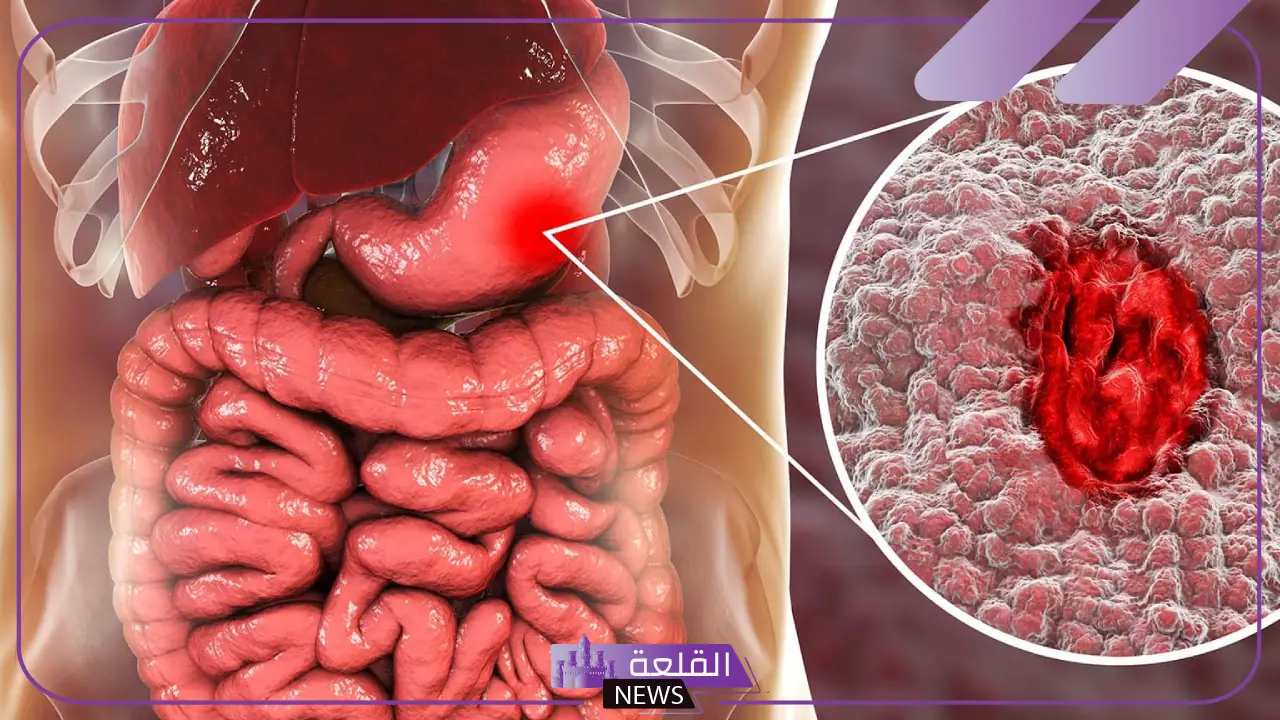 تجربتي في علاج قرحة المعدة بالأدوية ونصائح لنجاح العلاج 5 علاج قرحة المعدة بالأدوية