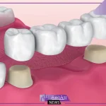 تجربتي مع جسر الاسنان لابتسامة رائعة ومدة النتيجة