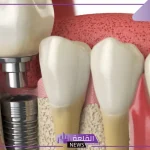 تجربتي مع زراعة عظم الفك لابتسامة سعيدة والآثار الجانبية