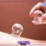 مستشار في التأهيل الطبي.. الحجامة تساهم في تحسن الدورة الدموية للمريض