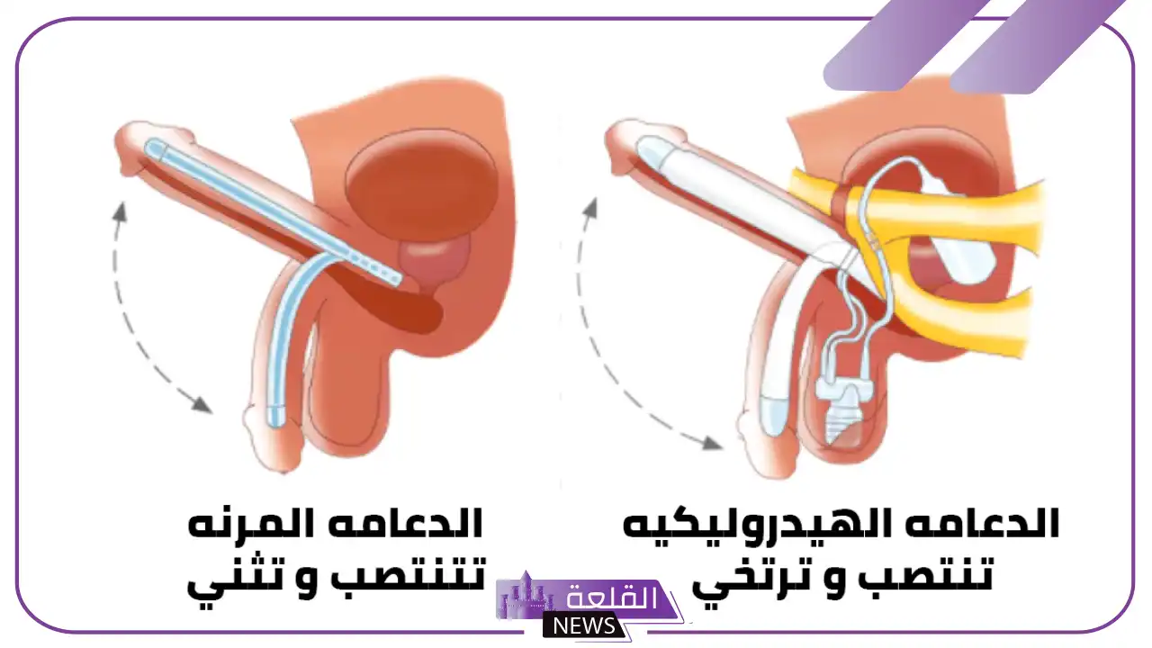 تجربتي مع الدعامه الذكريه لعلاج ضعف الانتصاب 5 فيديو تركيب دعامة الانتصاب