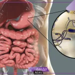 تجربتي في علاج قرحة المعدة بالأدوية ونصائح لنجاح العلاج