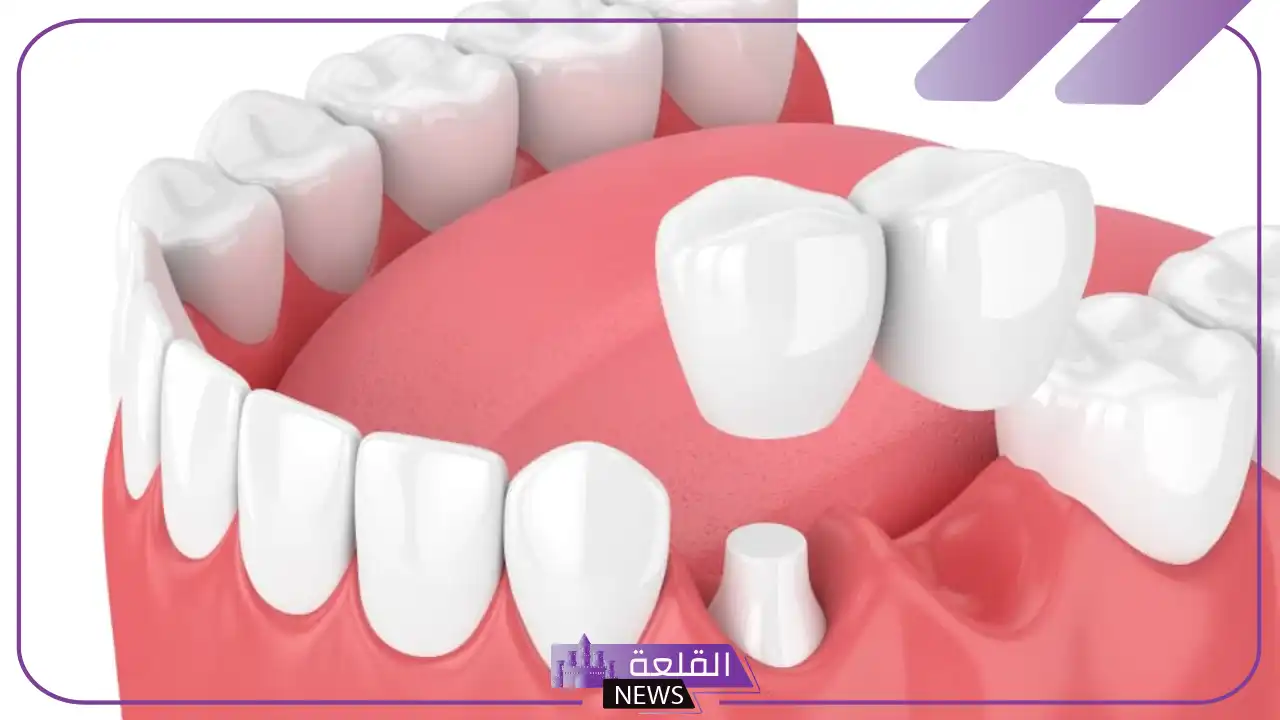 تجربتي مع جسر الاسنان لابتسامة رائعة ومدة النتيجة 5 هل تركيب جسر الأسنان مؤلم