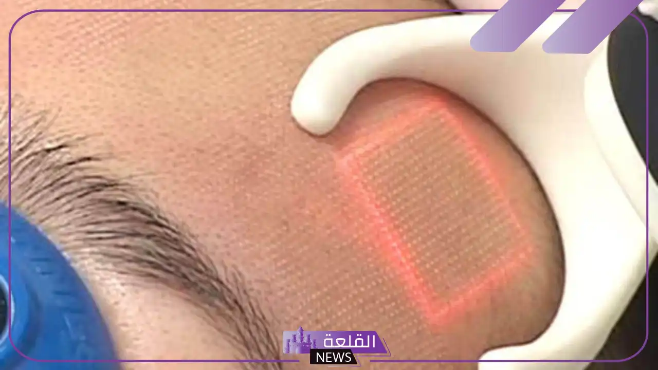 تجربتي فراكشنال ليزر للوجه لعلاج حب الشباب 5 متى تظهر نتائج الفراكشنال ليزر