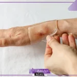 تجربتي مع لصقات السيليكون لعلاج الندبات