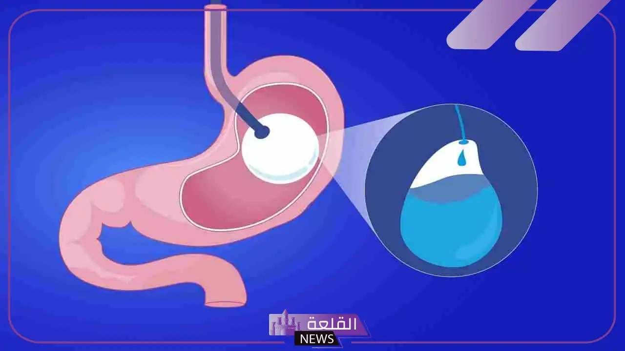 تجربتي مع بالون المعدة ونتائجها بالمميزات والعيوب 5 مميزات وعيوب بالون المعدة