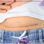 تفسير حلم شق البطن في المنام ونزول الدم لابن سيرين