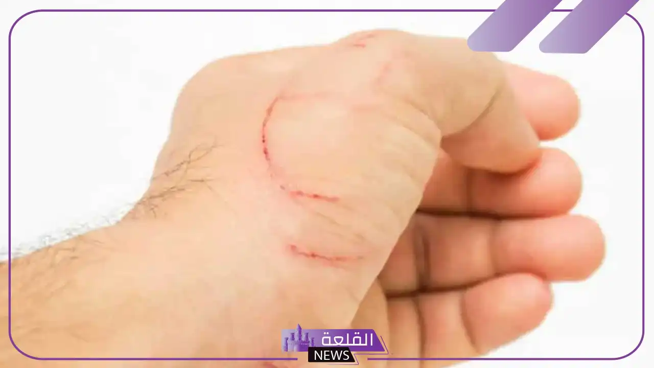 تفسير حلم رؤية الخدوش في المنام والجرح لابن سيرين في المنام 5 رؤية الخدوش في المنام