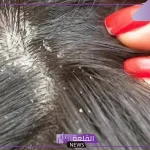 تفسير روية القمل في المنام لابن سيرين وقتله للمتزوجة والحامل