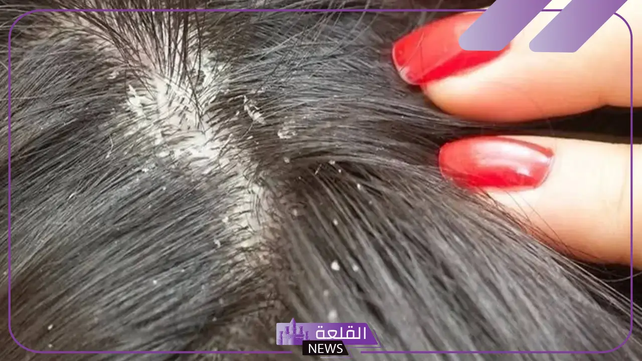 تفسير روية القمل في المنام لابن سيرين وقتله للمتزوجة والحامل