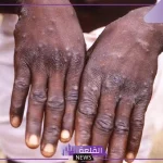 الصحة العالمية.. جدري القرود يثير القلق الدولي ويشكل حالة طوارئ حتى الآن