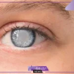 تفسير حلم فقدان عين واحدة في المنام لابن سيرين 