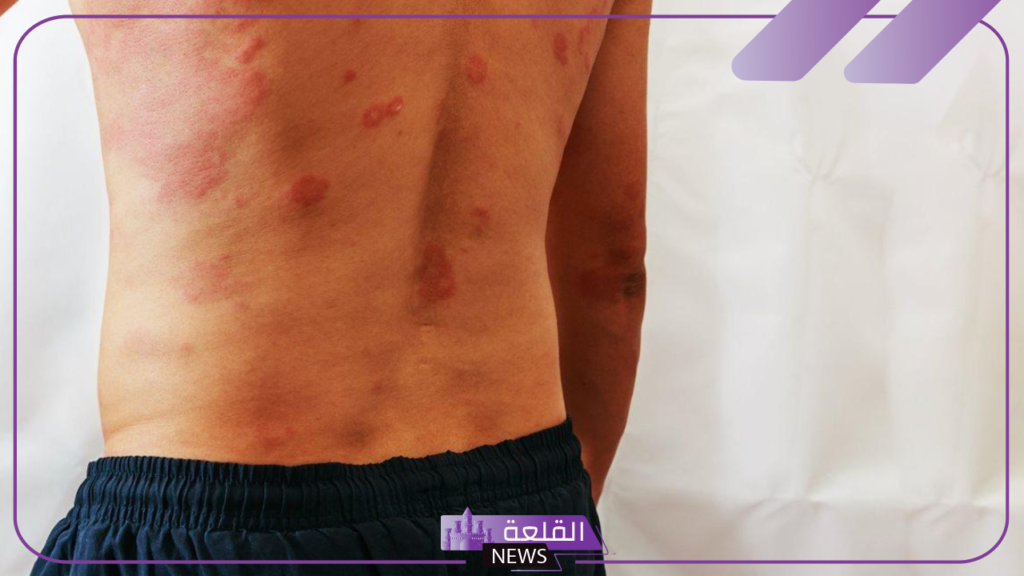بعد اكتشاف الحالة الأولى في مصر.. تعرف على كل ما يخص مرض فيكساس Vexas 5 أعراض مرض فيكساس