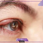 تفسير حلم العين المصابة في المنام للمرأة والرجل لابن سيرين