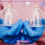 فوائد الحجامة للعين والحسد والسحر.. علامات خروج السحر بعد الحجامة 