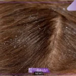 تفسير حلم القمل في المنام للمتزوجة لابن سيرين والنابلسي