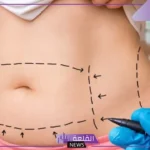 تفسير حلم عملية جراحية في البطن للمرأة والرجل لابن سيرين